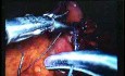 Jejunal Gastrointestinal Stromal tumor (GIST) (50 of 86)