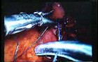 Jejunal Gastrointestinal Stromal tumor (GIST) (50 of 86)