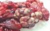 Metastasis of Renal Carcinoma to the ascending colon (10 of 11)