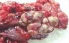 Metastasis of Renal Carcinoma to the ascending colon (10 of 11)