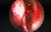 Allergic Fungal Sinusitis - Endoscopic Treatment