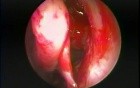 Allergic Fungal Sinusitis - Endoscopic Treatment