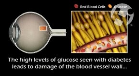 Retinopathy