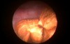 Urinary Bladder Stones