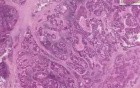 Adenocarcinoma, metastatic - Histopathology - Lymph node