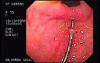Direct Visualization of Achalasia Pneumatic Dilation