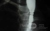 Congenital Esophageal Rings (4 of 5)