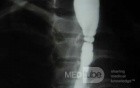 Congenital Esophageal Rings (4 of 5)
