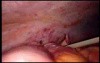 Colonic Perforation With Peritonitis - Laparoscopy (45 of 46)