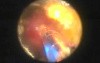 Bleeding Control With Greenlight HPS
