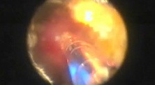 Bleeding Control With Greenlight HPS