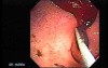 Duodenal Ulcer and Bleeding (4 of 23)