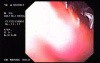 Duodenal Ulcers and Erosions (2 of 3)