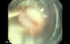 Upper GI bleeding due to Esophageal Varices - View Through Opaque Cylinder
