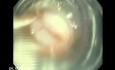 Upper GI bleeding due to Esophageal Varices - View Through Opaque Cylinder