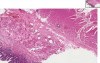 Barrett Esophagus 2