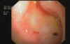 Bulbar Ulceration - Forrest II C