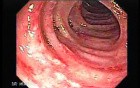 Diverticular Colitis (1 of 7)