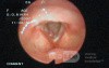 Vocal Fold Polyp