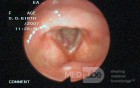 Vocal Fold Polyp