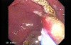 Multiple Adenomatous Polyps Of The Rectum (12 of 37)
