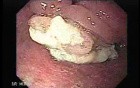 Esophageal Squamous Cell Carcinoma of the the Upper Third of the Esophagus that Invaded the Subglottis - Appearance of the Neoplasia