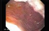 Gastric Adenocarcinoma With Varices - Endoscopy (8 of 8)
