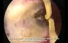 Hysteroscopic Treatment Of Uterine Synechia