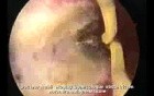 Hysteroscopic Treatment Of Uterine Synechia
