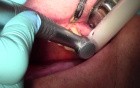 Clinical Crown Lengthening #14