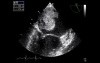 Myxoma In Cardiac Echo
