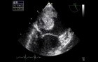 Myxoma In Cardiac Echo