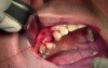 Suturing Technique - Implant Placement #5