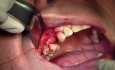 Suturing Technique - Implant Placement #5