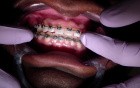Interproximal Reduction - Ortho Update - Explanation Of Case