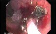 Endoscopic Resection of Giant Tubulo-Villous of the rectum (12 of 35)