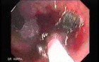 Endoscopic Resection of Giant Tubulo-Villous of the rectum (12 of 35)