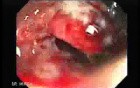 Familial Adenomatous Polyposis (24 of 36)