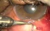 Transciliary Filtration - Fugo Blade