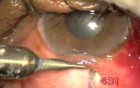 Transciliary Filtration - Fugo Blade
