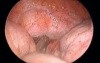 Appendectomy - SILS - TriPort