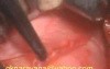 Revision Mastoidectomy Part 1: Infiltration, Incision, Graft