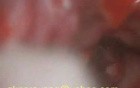 Revision Mastoidectomy 2: Canal Dissection,Mastoidectomy