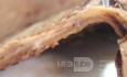 Small Gastric Adenocarcinoma of the Diffuse Ring Cell (18 of 19)