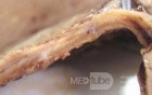 Small Gastric Adenocarcinoma of the Diffuse Ring Cell (18 of 19)