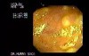Endoscopic View of Pseudomembranous Colitis