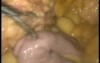 Conversion of Maison Technique to Roux En Y Gastric Bypass - Laparoscopy