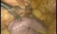 Conversion of Maison Technique to Roux En Y Gastric Bypass - Laparoscopy