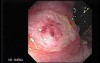 Rectal Dieulafoy’s Lesion (1 of 4)