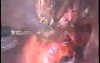Laparoscopic Polymyomectomy